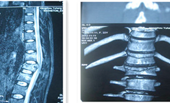 頸、胸、腰椎手術治療